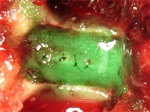 Adherus Spinal Sealant