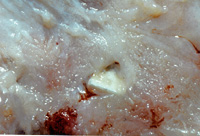 AZoM - Metals, ceramics, polymers and composites - ceramic composite materials used in spinal surgery.