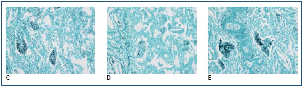 Photomicrographs of GMS staining using solutions of methenamine silver nitrate prepared with Elix® purified water (C), distilled water (D), or deionized water (E). Pictures courtesy of E. Macrea and W. Lange.