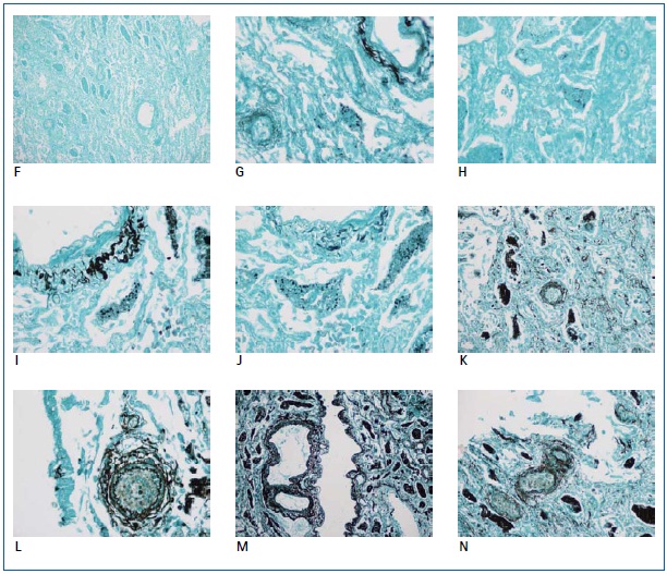 Photomicrographs of GMS staining using solutions of methenamine silver nitrate prepared with Elix® purified water and one of the following contaminants: potassium chromium sulfate (F), cupric sulfate (G), nickel sulfate (H), ferrous sulfate (I), sodium hypochlorite (J), sodium triphosphate (K), sodium silicate (L), endotoxin (M), humic acid (N). Pictures courtesy of E. Macrea and W. Lange.