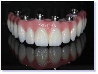 Dental frameworks
