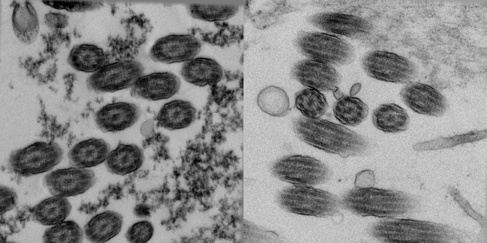 Untilted views of epithelial brush borders of healthy (left) and PCD-afflicted individuals (right).