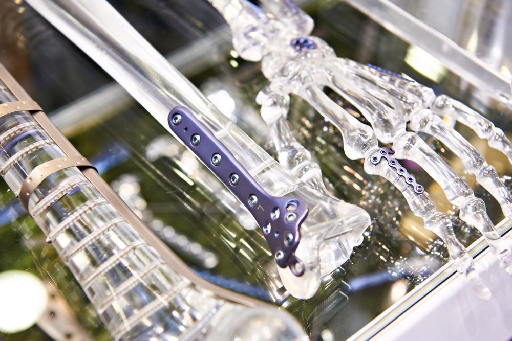 implants, alloys, artificial joint replacement, orthopedic