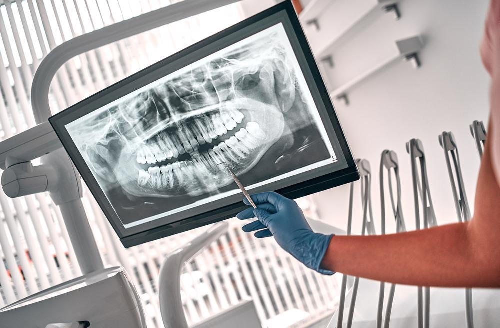 graphene, dentistry, cavities, nanomaterials, graphene oxide