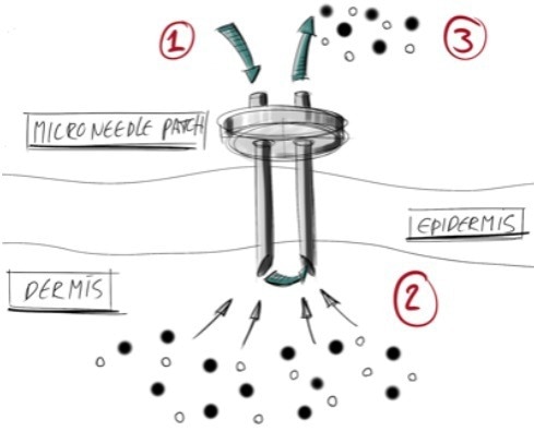 Micro 3D Printing for Skin Cancer Treatment Device