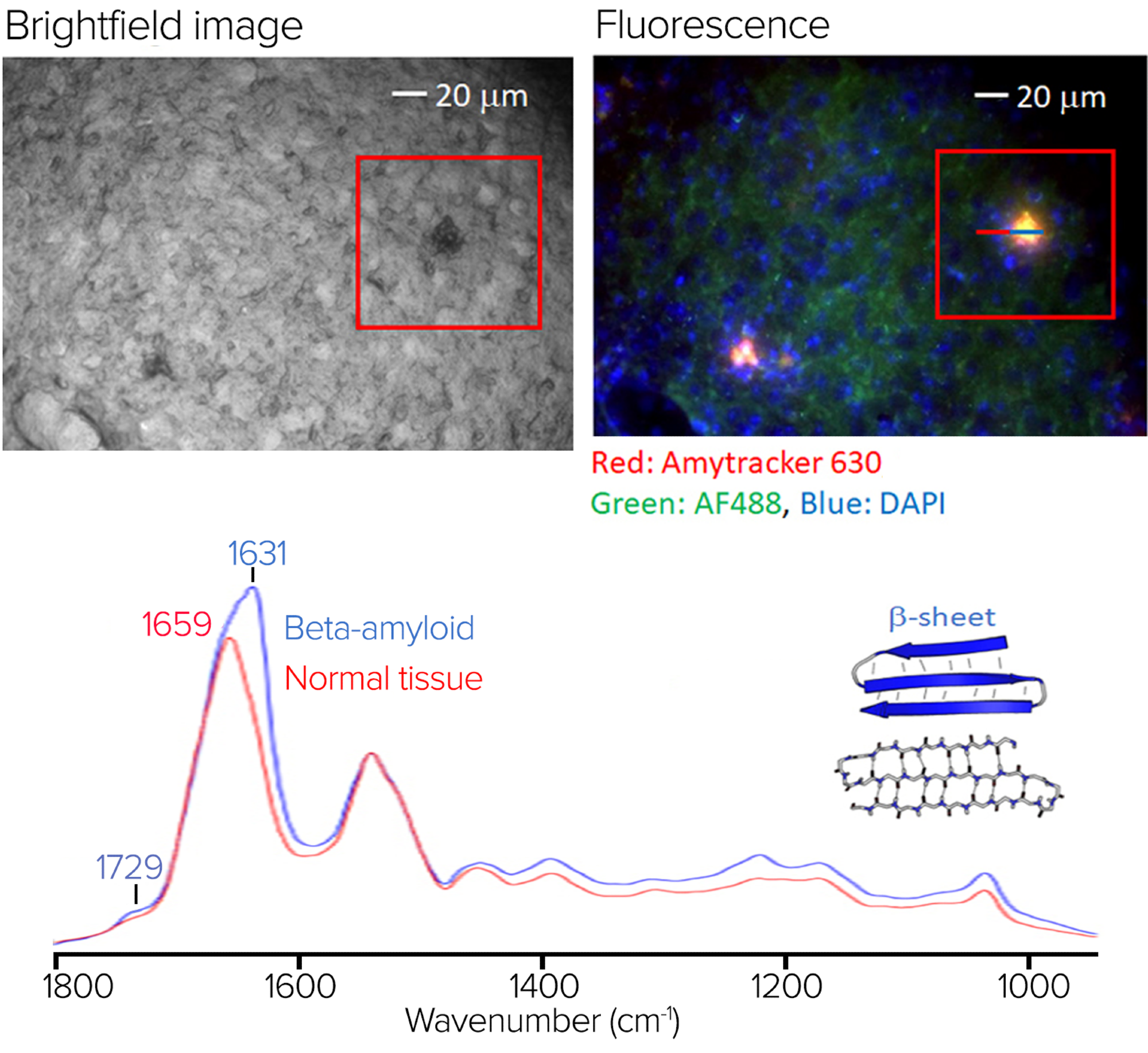 Tissue sample stained (Amytracker 630) for the presence of beta-amyloid aggregates. Spectra collected on and off the fluorescence hotspots show strong spectral features at 1631cm-1 characteristic of protein beta sheet structures.