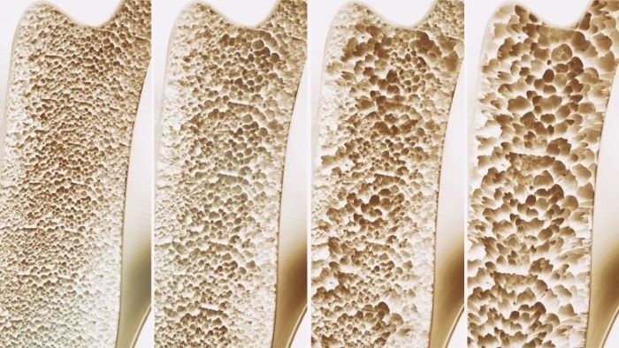 Raman spectroscopy can be used to gauge bone density and bone quality, critical markers of osteoporosis