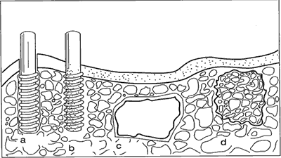 Classification of bioceramics according to their bioactivity; (a) bioinert, (alumina dental implant), (b) bioactive, hydroxyapatite (Ca10(PO4)6(OH)2) coating on a metallic dental implant, (c) surface active, bioglass or A-W glass, (d) bioresorbable tri-calcium phosphate implant [Ca3(PO4)2].