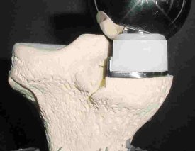 Set up for evaluating a polyethylene bearing surface in a knee implant.