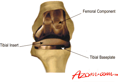 A typical knee replacement showing the femoral and tibial components