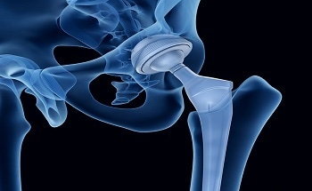 FDA Approves 3D-Printed Titanium Pelvic Implant