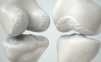 How Could Limbs be Repaired using Recent 3D Printing Technology?