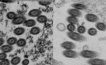 Using Tomography for Primary Ciliary Dyskinesia