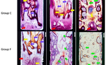 Alloys with New Antibacterial Coating to Promote Bone Growth