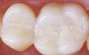 Measuring the Effect of Polymerization on Dental Composites
