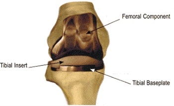 Challenges for the Standard Knee Prosthesis Testing Procedure