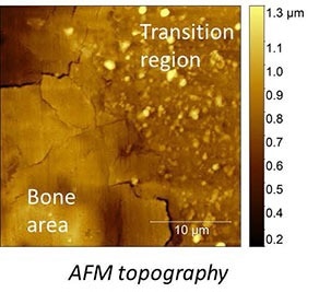 AFSEM image of bone sample with a partially dissolved implant obtained in force volume mode. (Figure 1) AFM Topography image of the bone area and transition region, where the implant is partially dissolved