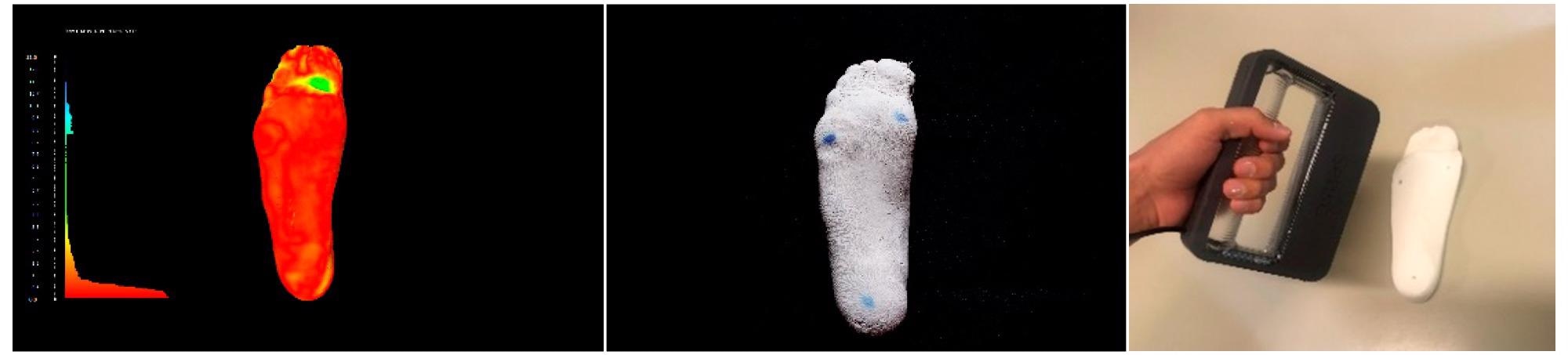 3D Printing Patient-Specific Foot Orthoses