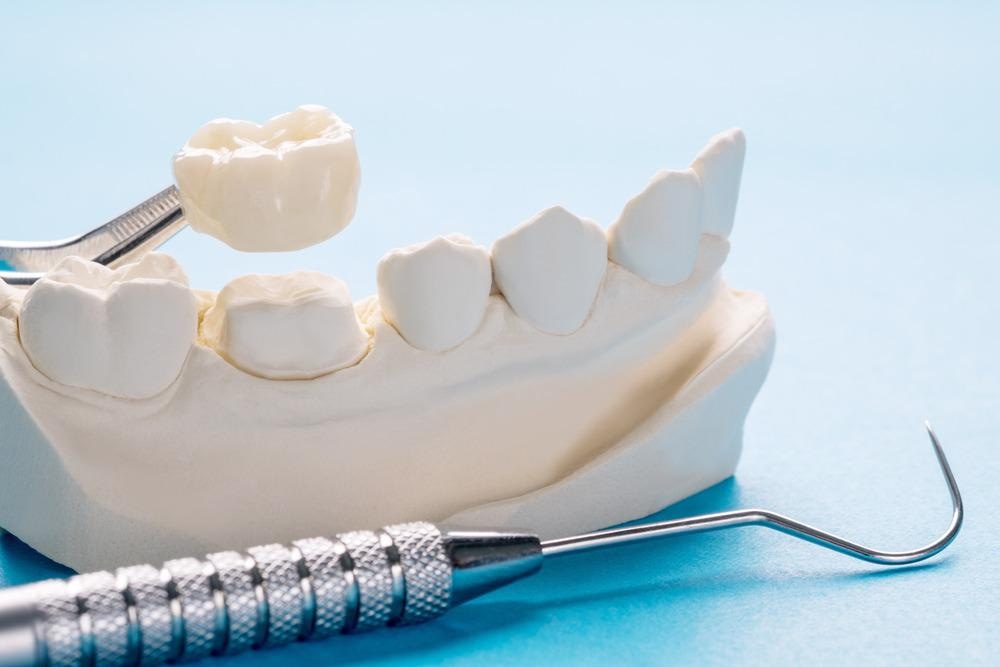 peek, polymer, dentistry