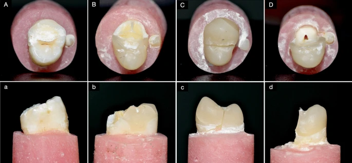The characteristics of the observed fractures are shown in occlusal view (uppercase letters) and proximal view (lowercase letters). In the control group, the fracture was always within the dentin (A) and it was always above the CEJ (a). In the overlay-restored groups, four of the forty-two specimens involved only the restoration and dentin (B) and three of these unusual specimens were above the CEJ (b). All of the other overlay-restored specimens fractures involved pulp tissue (C and D) below the CEJ (c and d). Roughly half of those specimens fractured across the middle of the tooth (C and c), and in the others a large portion of the tooth fell off (D and d).