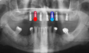 Linkoping Researchers Study Drug Coating for Dental Implants