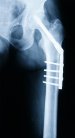 First Peer-Reviewed Materials Database on Medical Device Design