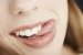 Glass Fibre Helps to Restore Smiles