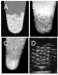 Nanoparticle Treatment for Type 1 Diabetes to be Commercialized