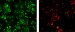 Carbon Nanotubes to Detect and Destroy Breast Cancer