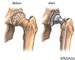 Researchers Study New Reinforced Materials for Hip Implants