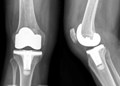 Nanodiamond Coating Reduces Release of Inflammatory Chemicals Around Implants