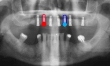 Linkoping Researchers Study Drug Coating for Dental Implants