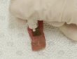 New Chitosan-Based Laser-Activated Bio-Adhesive Polymer