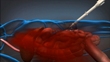 Polyurethane Polymer Foam Slows Blood Loss in Victims of Internal Hemorrhaging