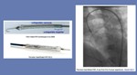 Heart Pump Developed by Penn State ARL and Materials Science Researchers Successfully Tested