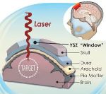 University of California, Riverside Researchers Develop Novel Transparent Ceramic Implant for Neurological Disorders