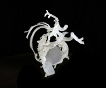 Using 3D-Printed Models to Treat Complex Blood Vessel Malformations in Brain