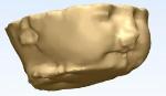 3D Printing Helps Determine Necessity of Complex Surgical Delivery Procedure