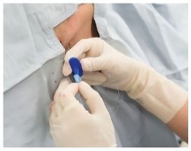 Real-Time Needle-Tip Spectroscopy Could be a Potential Alternative to Epidural Steroid Injections