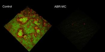 New Dental Material has a Resin Embedded with the Antibacterial Agent Imidazolium