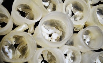 New 3D-Printed Workflow Enhances Valve Sizing Accuracy for Aortic Valve Replacement Procedures