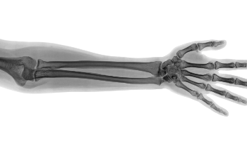 The Development of 3D Printed Custom-Made Bones