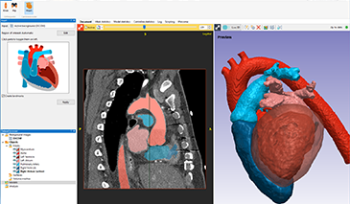New AI-Based Heart Segmentation and Many New and Improved Features in Simpleware Q-2020.06