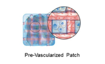 Novel Cardiac Patch Could Help Treat Myocardial Infarction Effectively