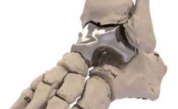 3D Printed Metal Ankle Bone is a Step Forward for Orthopedics