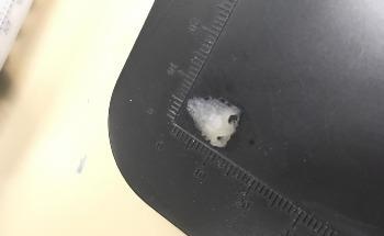 Using 3D Printing to Aid Tissue Replacement