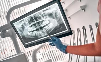 Investigating Hybrid Polymer CAD/CAM Restorations for Dental Applications