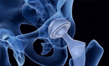 Researchers Use Bioactive Materials to Make Enhanced Orthopedic Implants