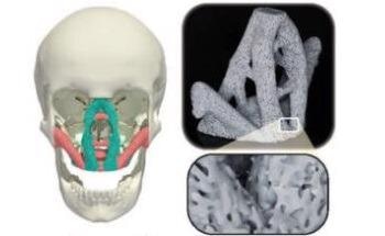 Bio-Inspired Sturdy, Lightweight Porous Materials for Bone Implants and Aircraft