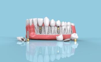 What Particles are Released from Dental Implants After Placement?